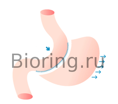 Вертикальная рукавная гастрэктомия на фото : Вертикальная рукавная гастрэктомия - схема операции по лечению ожирения